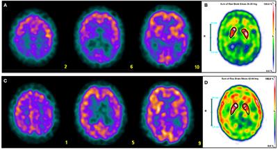 Brain SPECT as a Biomarker of Neurodegeneration in Dementia in the Era of Molecular Imaging: Still a Valid Option?